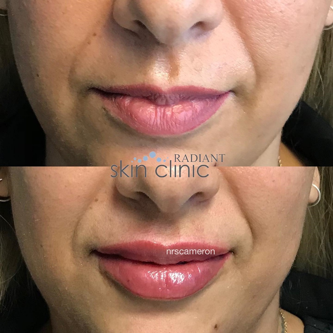 Lip Filler website